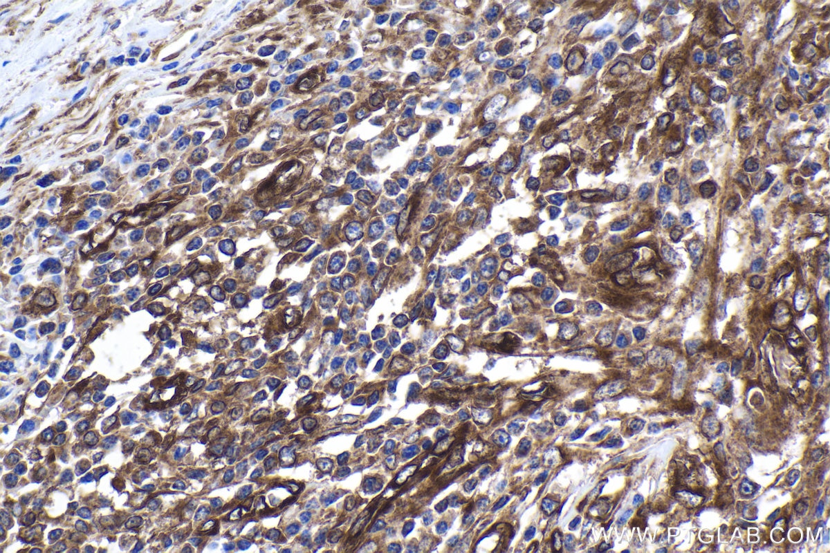 Immunohistochemical analysis of paraffin-embedded human ovary tumor tissue slide using KHC1880 (PRICKLE1 IHC Kit).