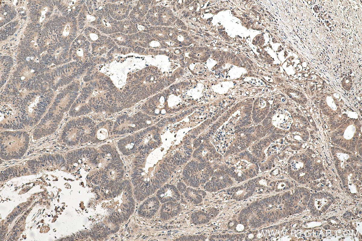 Immunohistochemical analysis of paraffin-embedded human colon cancer tissue slide using KHC0600 (AMPK Alpha 1 IHC Kit).