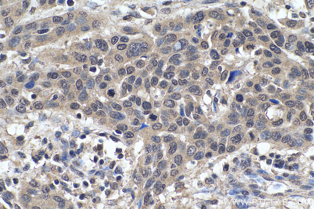 Immunohistochemical analysis of paraffin-embedded human oesophagus cancer tissue slide using KHC0600 (AMPK Alpha 1 IHC Kit).