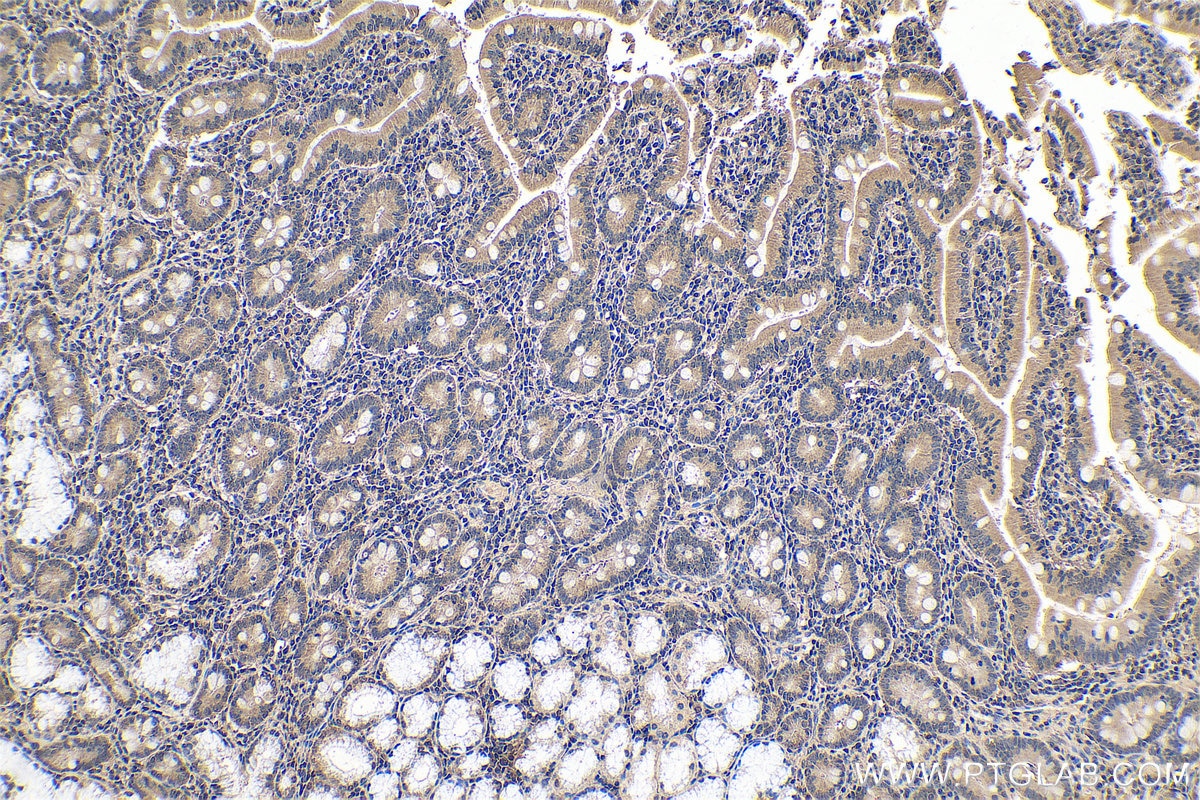 Immunohistochemical analysis of paraffin-embedded human stomach cancer tissue slide using KHC0600 (AMPK Alpha 1 IHC Kit).