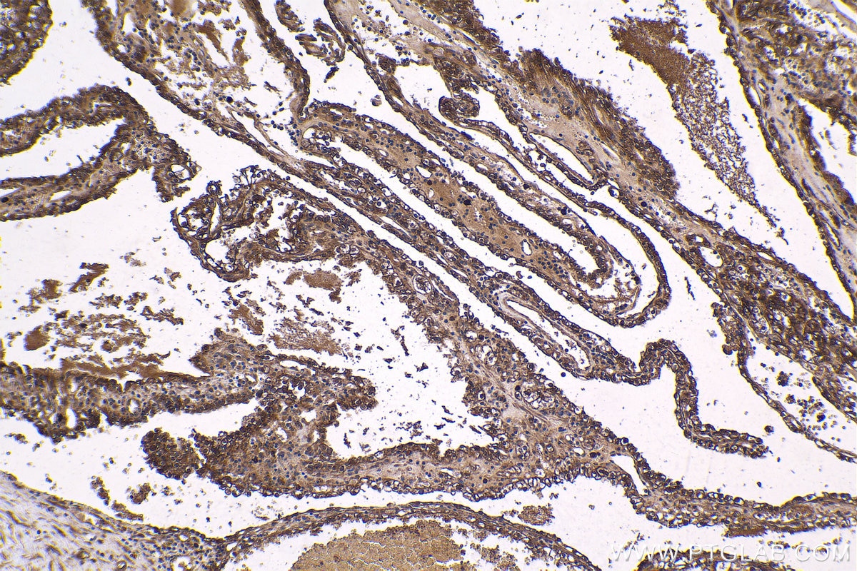 Immunohistochemical analysis of paraffin-embedded human renal cell carcinoma tissue slide using KHC1628 (PRKAA2 IHC Kit).