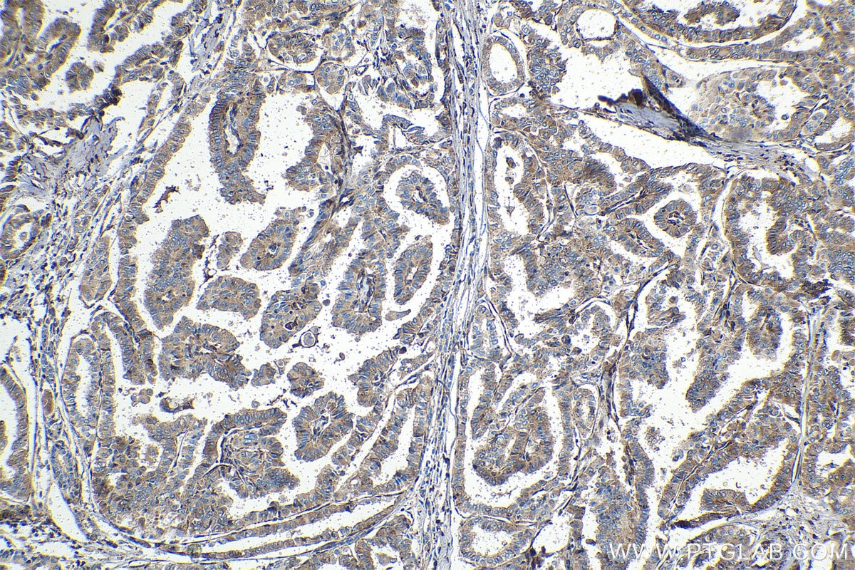 Immunohistochemical analysis of paraffin-embedded human thyroid cancer tissue slide using KHC1540 (PRKACA IHC Kit).