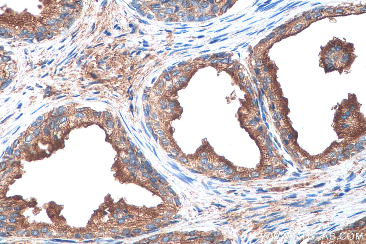 Immunohistochemical analysis of paraffin-embedded human prostate cancer tissue slide using KHC0924 (PRKAR2A IHC Kit).