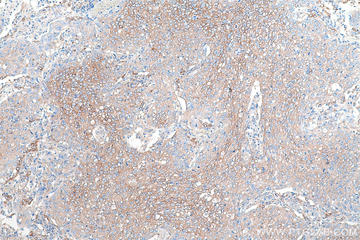 Immunohistochemical analysis of paraffin-embedded human lung cancer tissue slide using KHC0924 (PRKAR2A IHC Kit).