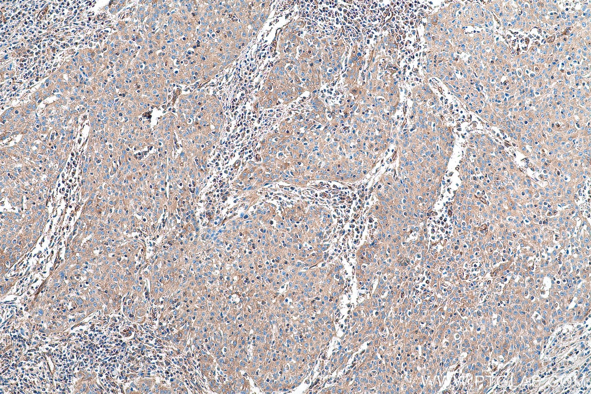 Immunohistochemical analysis of paraffin-embedded human cervical cancer tissue slide using KHC0924 (PRKAR2A IHC Kit).