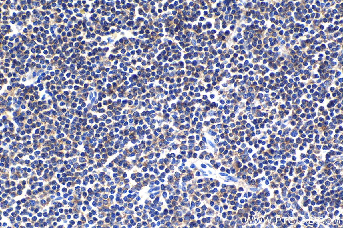 Immunohistochemical analysis of paraffin-embedded human lymphoma tissue slide using KHC1539 (PRKCA IHC Kit).