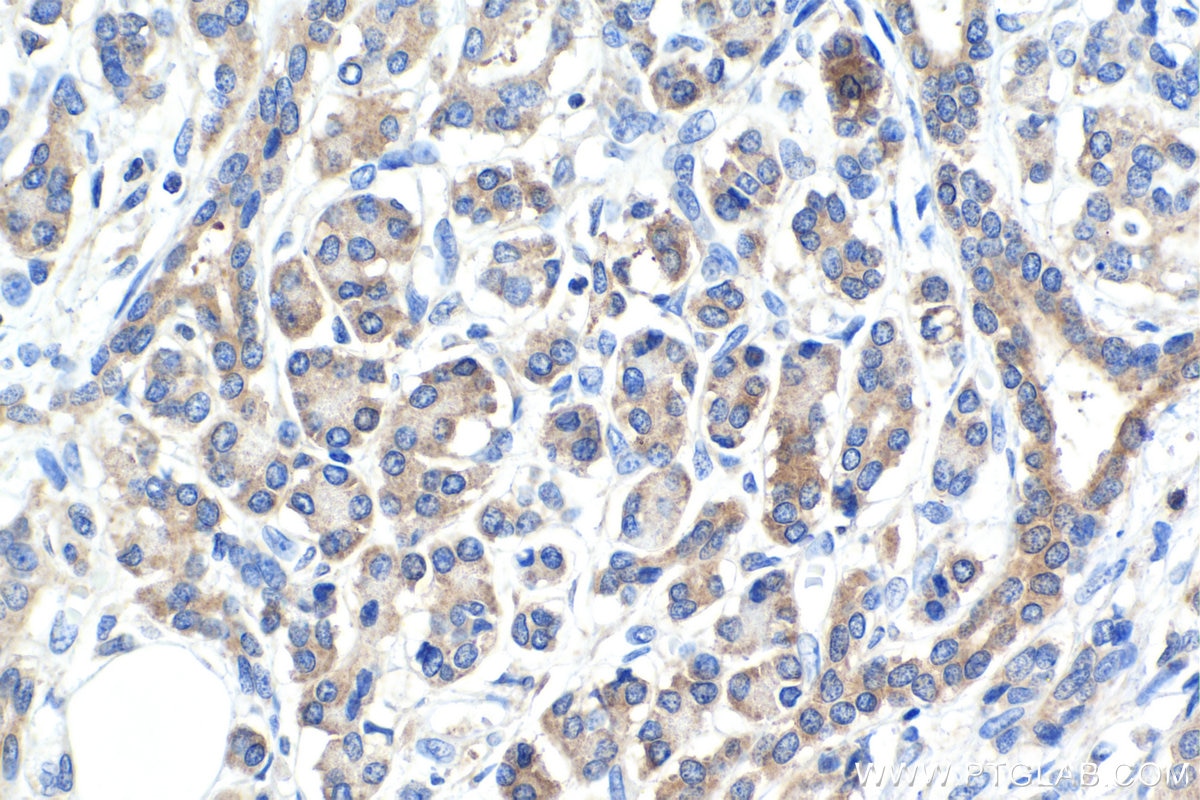 Immunohistochemical analysis of paraffin-embedded human pancreas cancer tissue slide using KHC1539 (PRKCA IHC Kit).