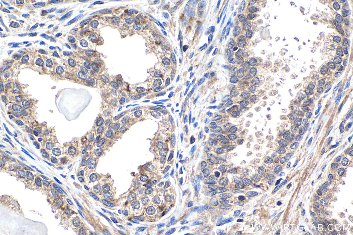 Immunohistochemical analysis of paraffin-embedded human prostate cancer tissue slide using KHC1510 (PRKCB IHC Kit).