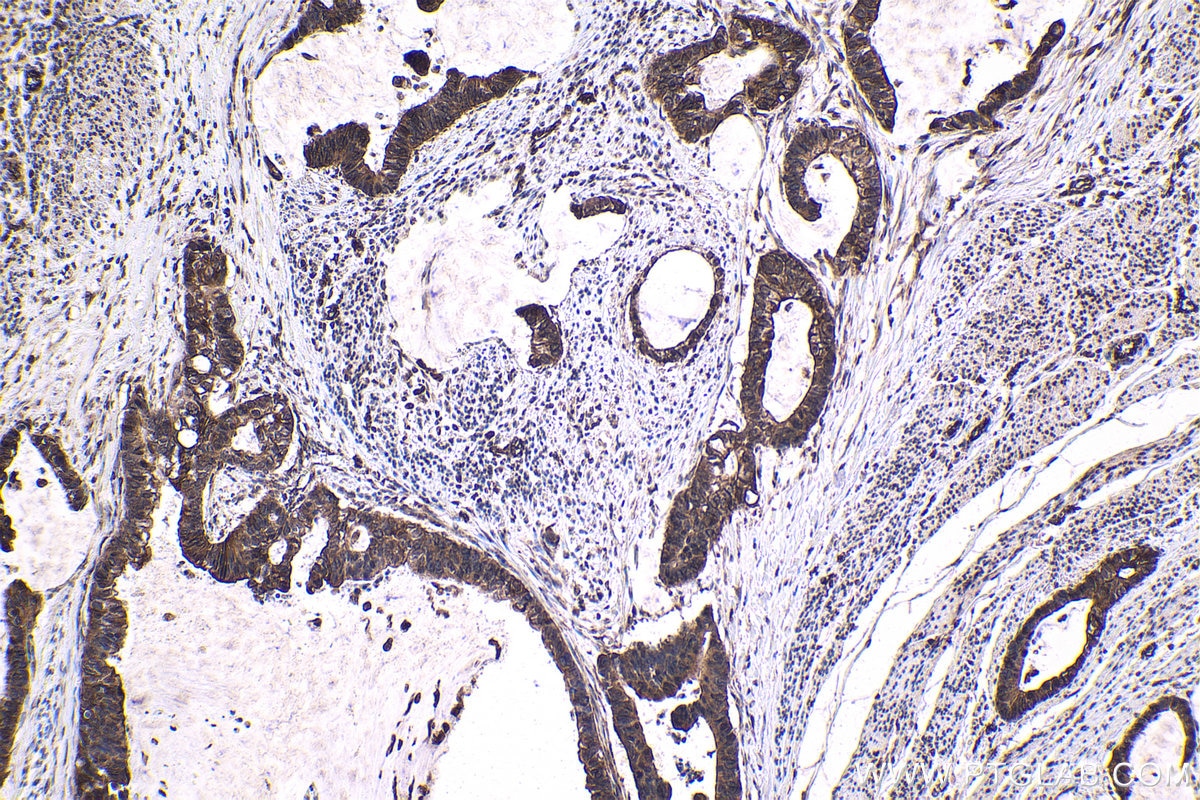 Immunohistochemical analysis of paraffin-embedded human urothelial carcinoma tissue slide using KHC1676 (PRKCD IHC Kit).