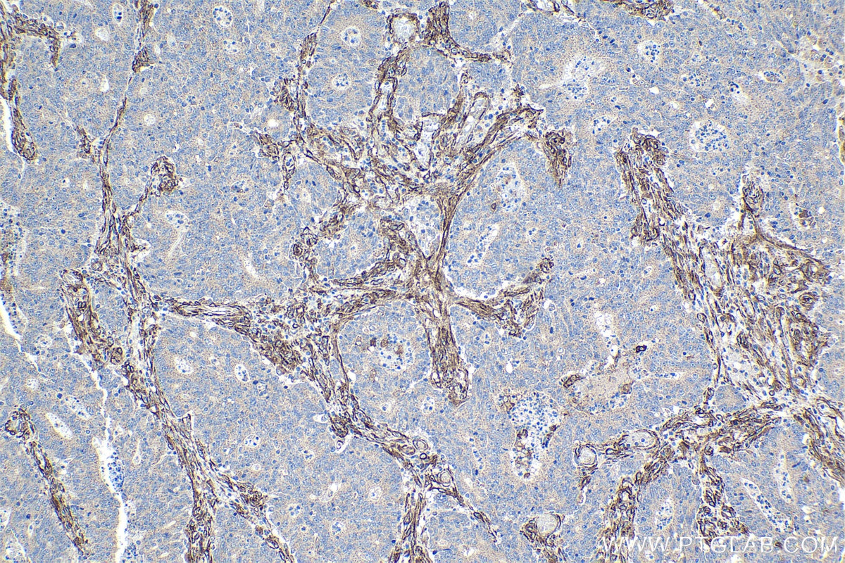 Immunohistochemical analysis of paraffin-embedded human colon cancer tissue slide using KHC1081 (PRKCDBP/CAVIN3 IHC Kit).