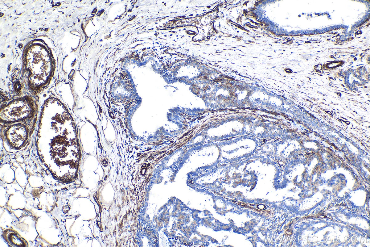 Immunohistochemical analysis of paraffin-embedded human breast cancer tissue slide using KHC1081 (PRKCDBP/CAVIN3 IHC Kit).