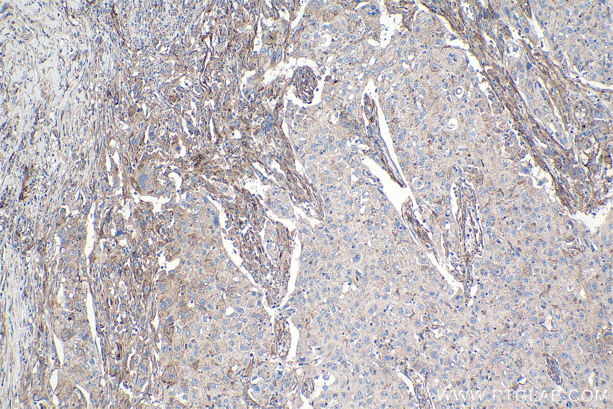 Immunohistochemical analysis of paraffin-embedded human lung cancer tissue slide using KHC1081 (PRKCDBP/CAVIN3 IHC Kit).