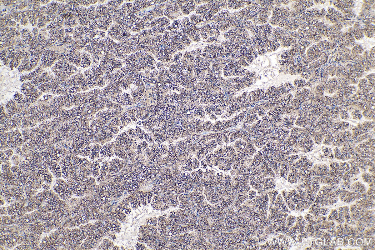 Immunohistochemical analysis of paraffin-embedded human lung cancer tissue slide using KHC0786 (PRKCI IHC Kit).