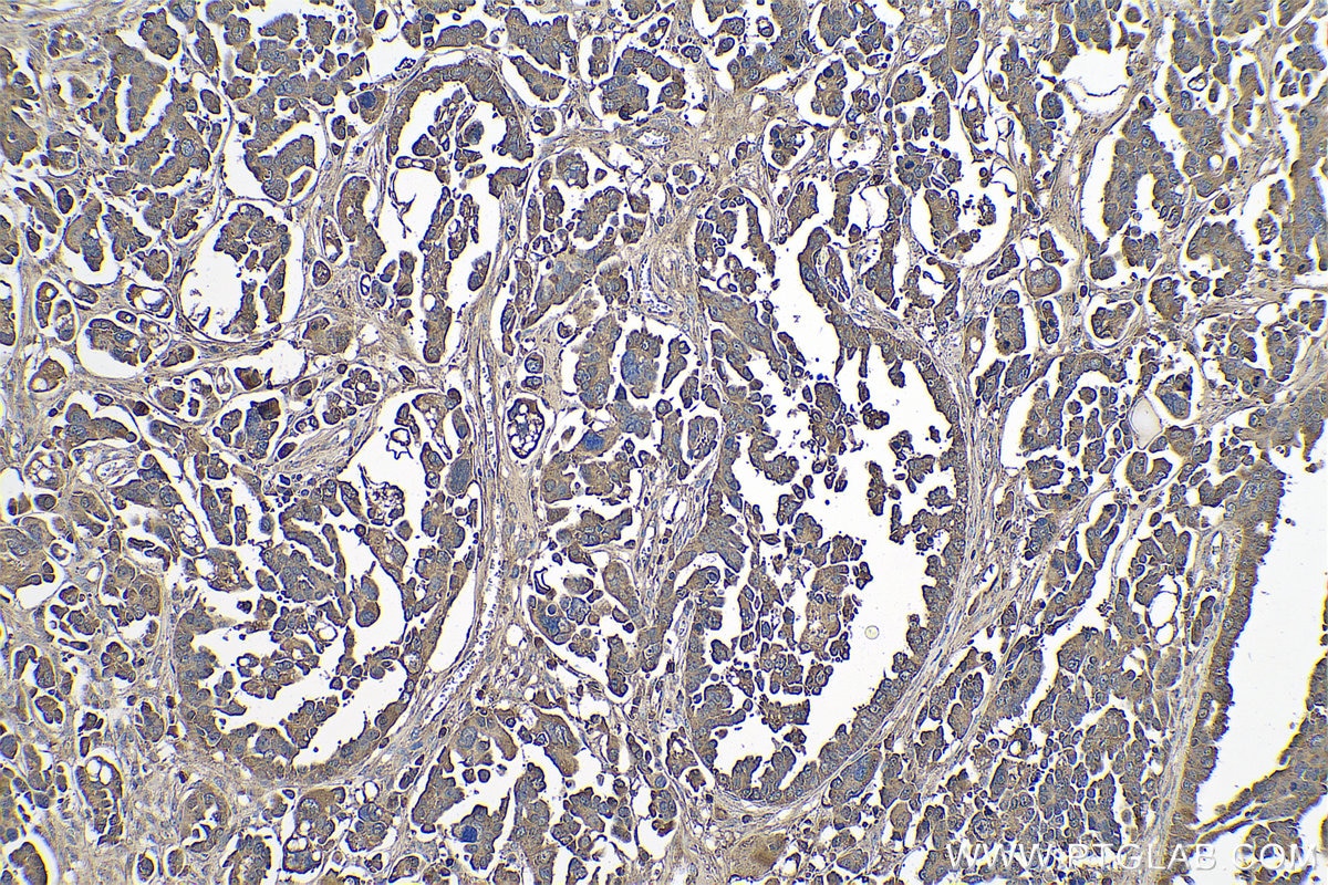 Immunohistochemical analysis of paraffin-embedded human colon cancer tissue slide using KHC0786 (PRKCI IHC Kit).