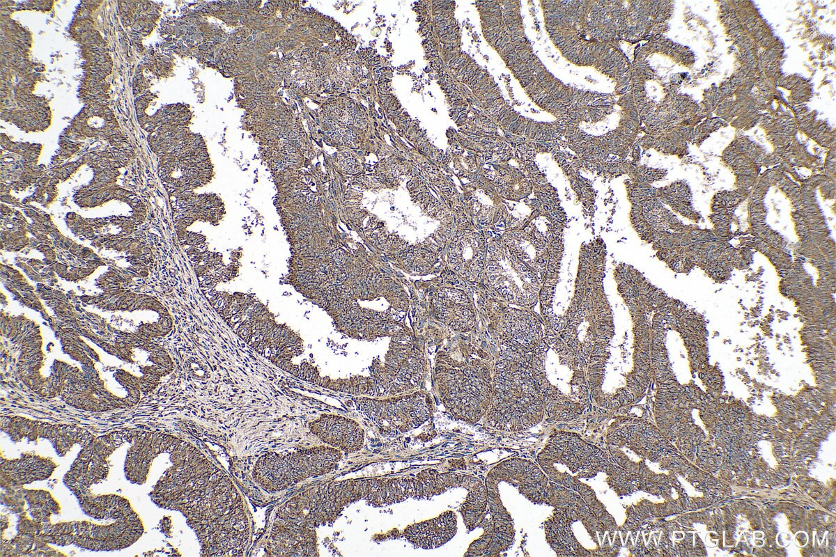 Immunohistochemical analysis of paraffin-embedded human ovary tumor tissue slide using KHC0786 (PRKCI IHC Kit).