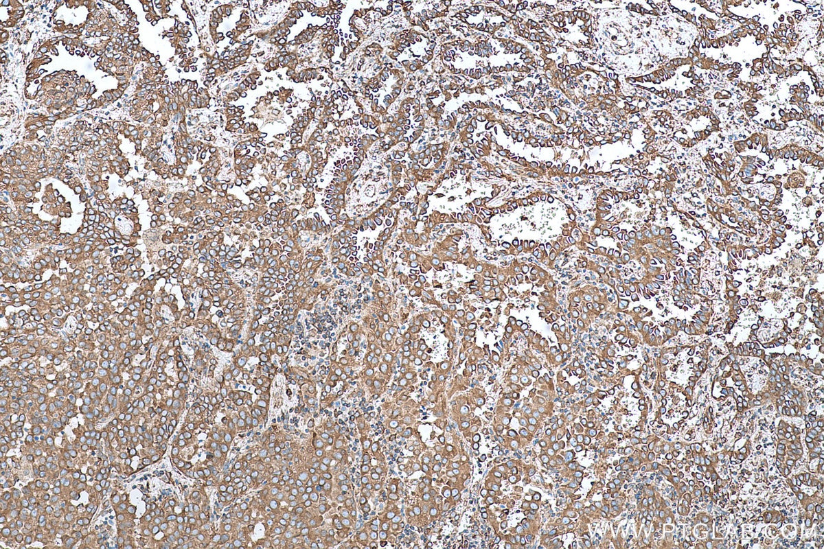 Immunohistochemical analysis of paraffin-embedded human lung cancer tissue slide using KHC0698 (PRKCSH IHC Kit).