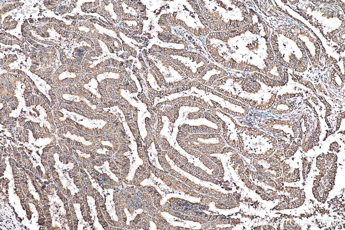 Immunohistochemical analysis of paraffin-embedded human ovary tumor tissue slide using KHC0698 (PRKCSH IHC Kit).