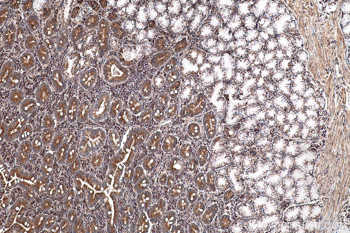 Immunohistochemical analysis of paraffin-embedded human stomach cancer tissue slide using KHC0698 (PRKCSH IHC Kit).