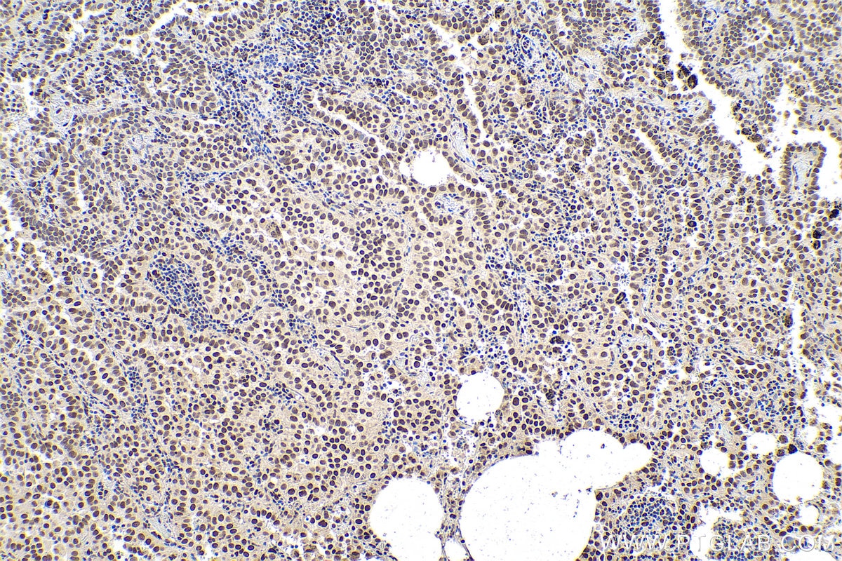 Immunohistochemical analysis of paraffin-embedded human lung cancer tissue slide using KHC0832 (PRMT1 IHC Kit).