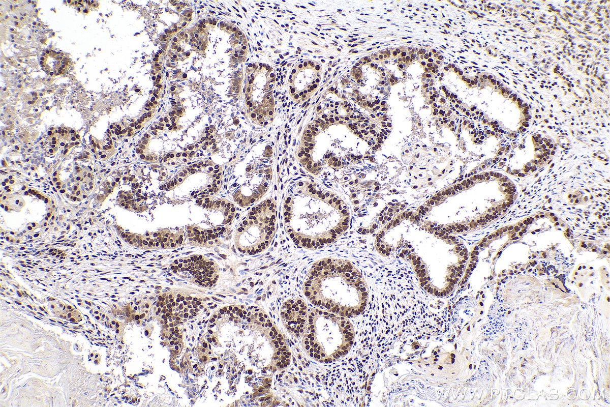 Immunohistochemical analysis of paraffin-embedded human ovary tumor tissue slide using KHC0832 (PRMT1 IHC Kit).