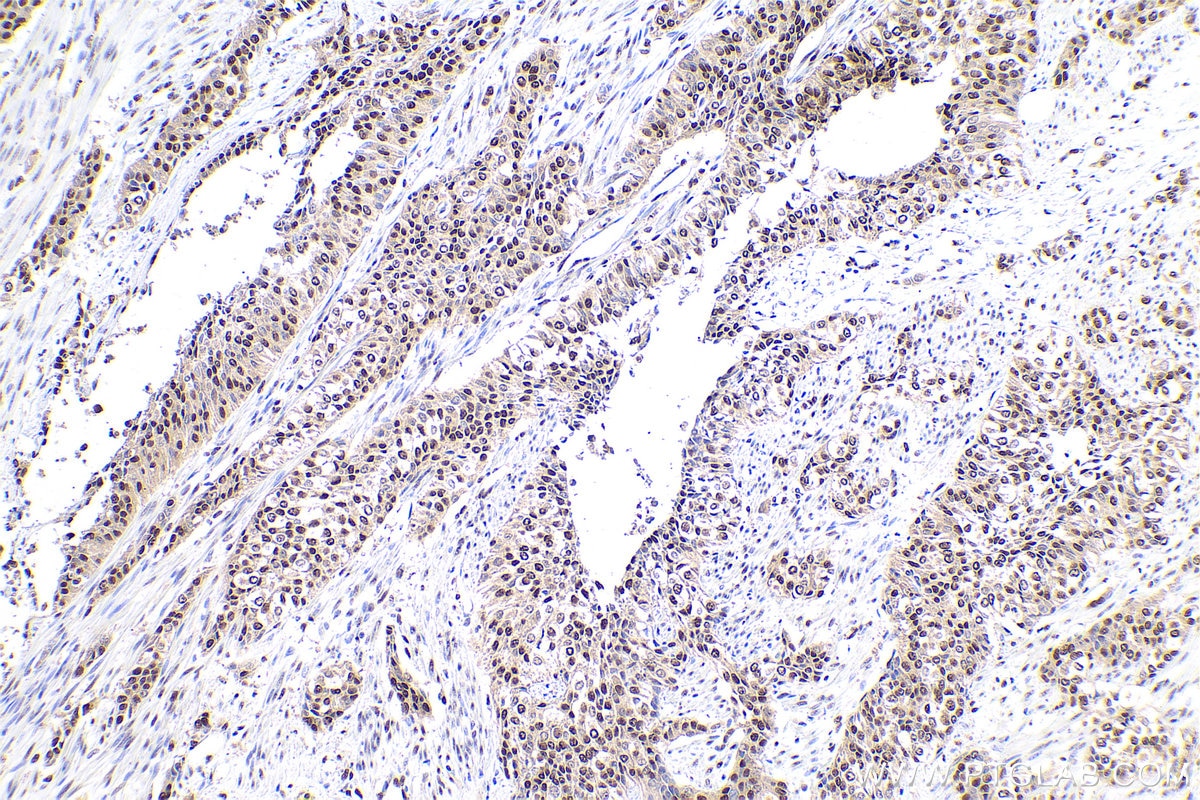 Immunohistochemical analysis of paraffin-embedded human urothelial carcinoma tissue slide using KHC0832 (PRMT1 IHC Kit).