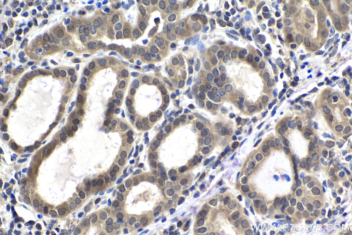 Immunohistochemical analysis of paraffin-embedded human thyroid cancer tissue slide using KHC1630 (PRMT2 IHC Kit).