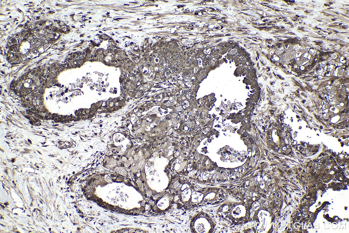 Immunohistochemical analysis of paraffin-embedded human pancreas cancer tissue slide using KHC1630 (PRMT2 IHC Kit).