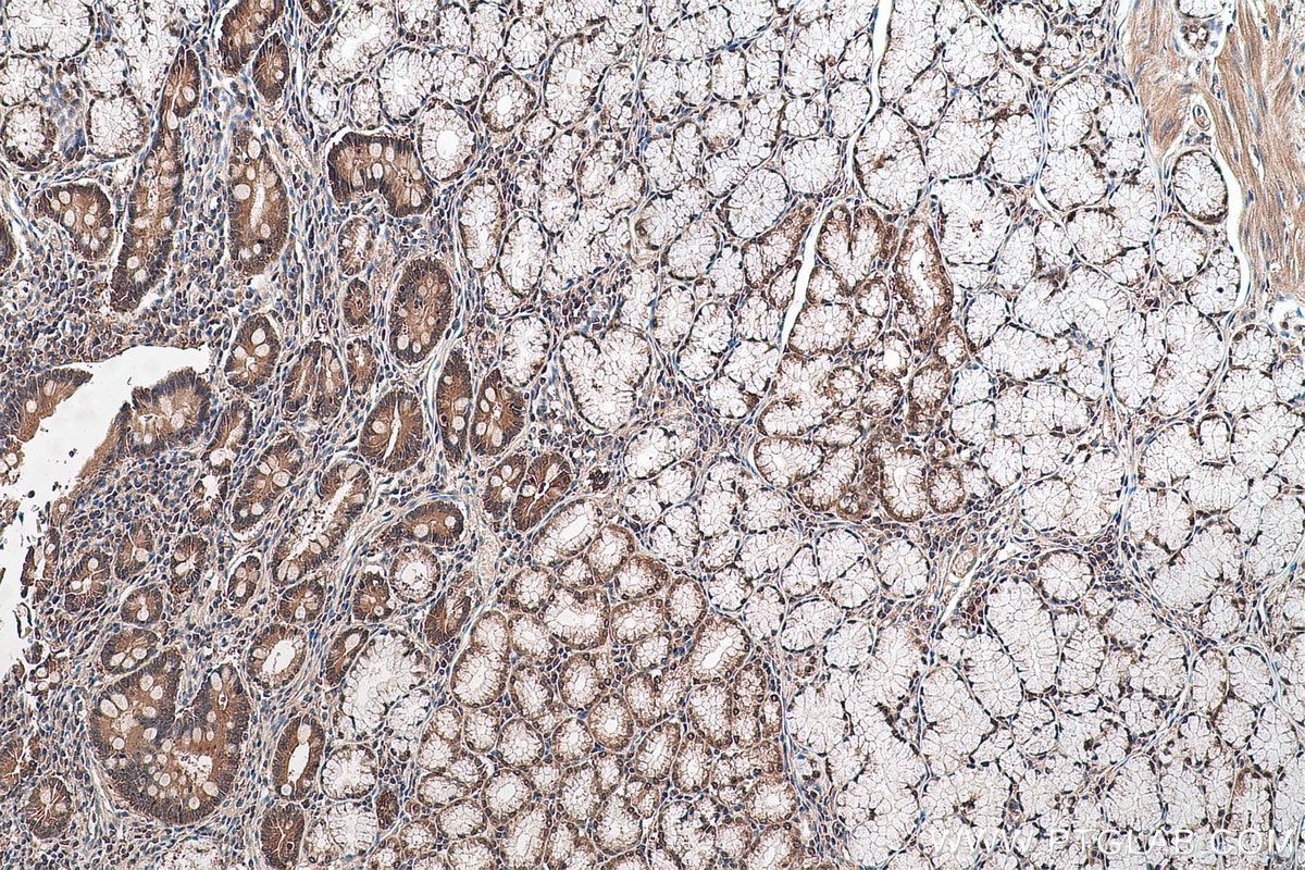 Immunohistochemical analysis of paraffin-embedded human stomach cancer tissue slide using KHC0636 (PRMT5 IHC Kit).