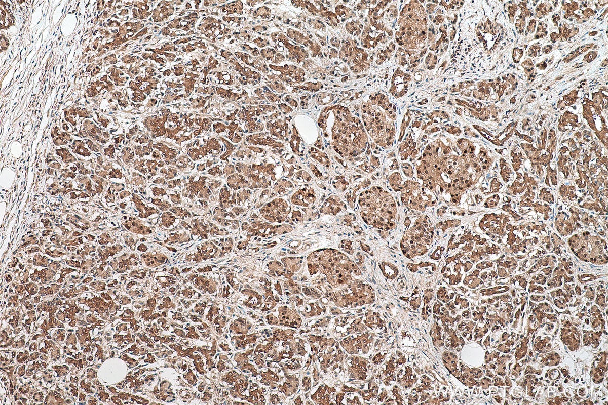 Immunohistochemical analysis of paraffin-embedded human pancreas cancer tissue slide using KHC0636 (PRMT5 IHC Kit).