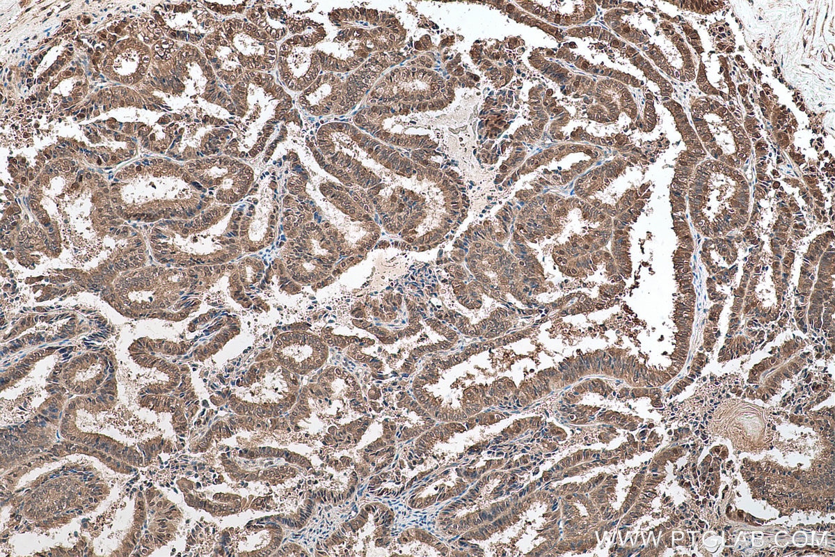 Immunohistochemical analysis of paraffin-embedded human ovary tumor tissue slide using KHC0636 (PRMT5 IHC Kit).
