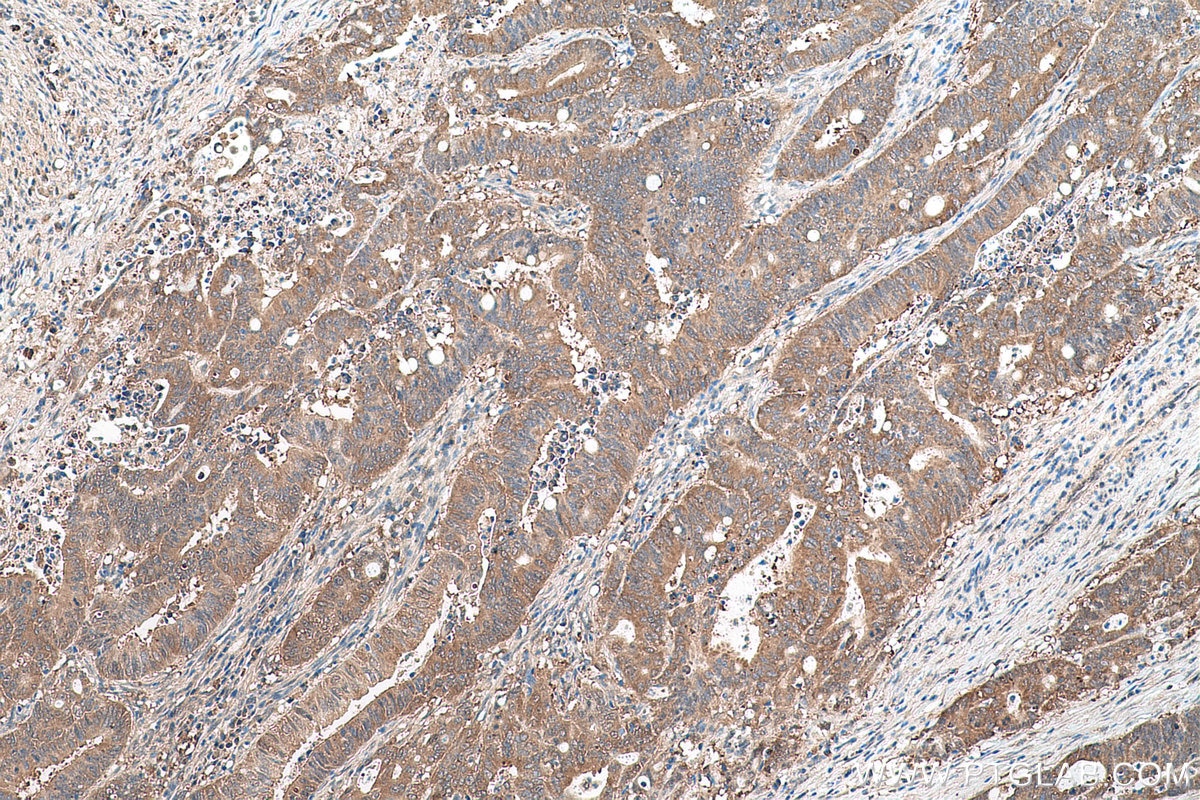 Immunohistochemical analysis of paraffin-embedded human colon cancer tissue slide using KHC0636 (PRMT5 IHC Kit).