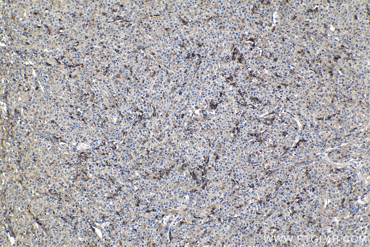 Immunohistochemical analysis of paraffin-embedded human cervical cancer tissue slide using KHC1191 (PRNP IHC Kit).