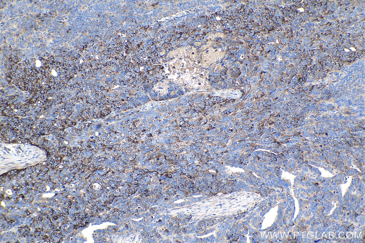Immunohistochemical analysis of paraffin-embedded human ovary tumor tissue slide using KHC1191 (PRNP IHC Kit).