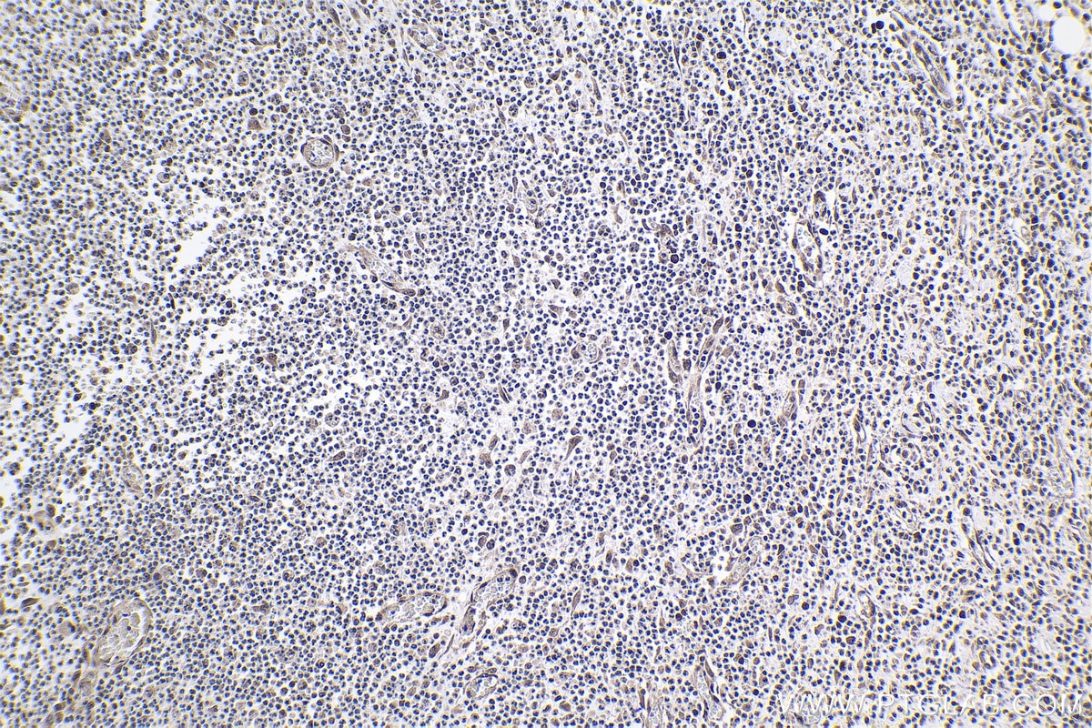 Immunohistochemical analysis of paraffin-embedded human colon cancer tissue slide using KHC1003 (PRPF40A IHC Kit).