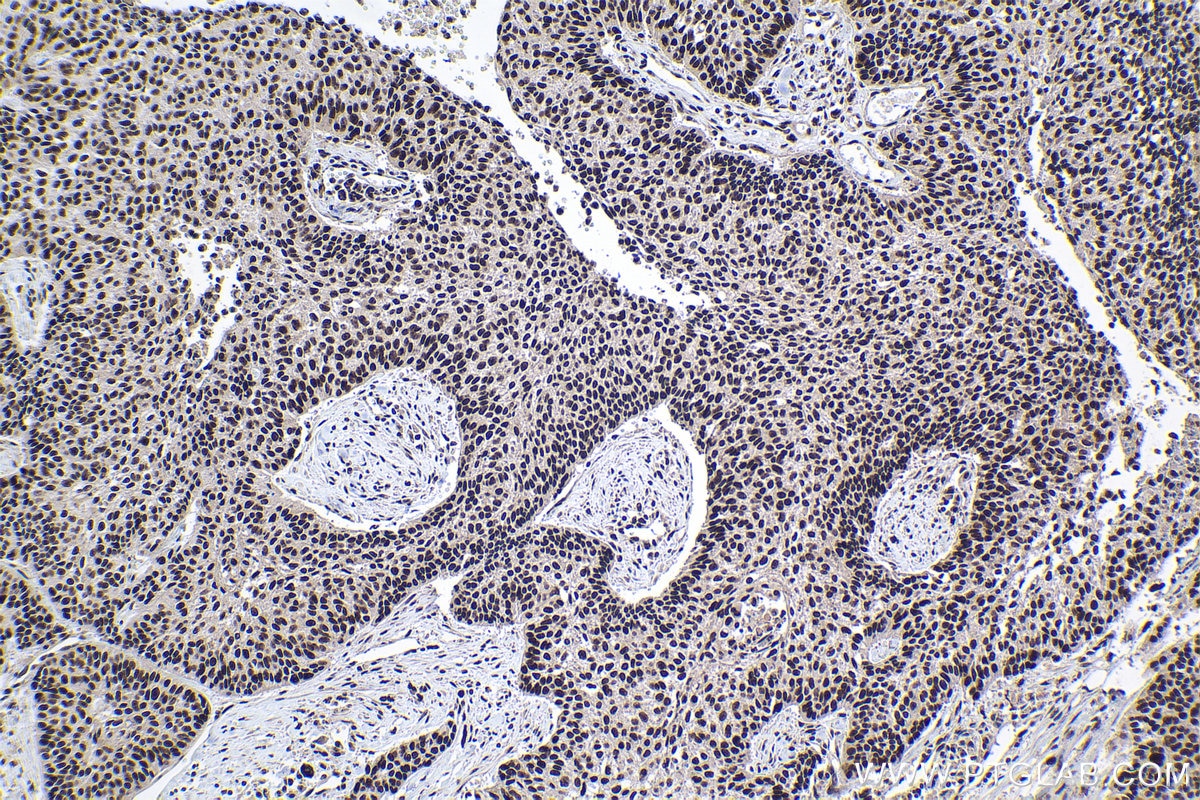 Immunohistochemical analysis of paraffin-embedded human lung cancer tissue slide using KHC1003 (PRPF40A IHC Kit).