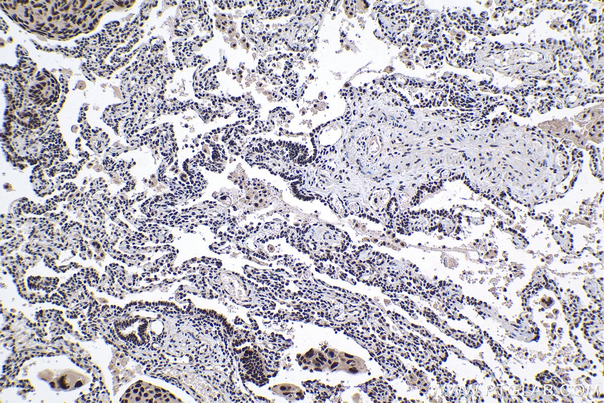 Immunohistochemical analysis of paraffin-embedded human lung cancer (ANCT) tissue slide using KHC1003 (PRPF40A IHC Kit).