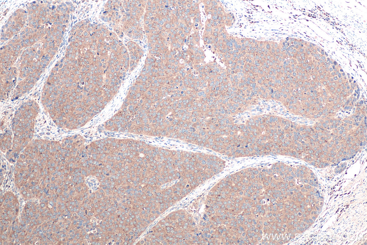 Immunohistochemical analysis of paraffin-embedded human stomach cancer tissue slide using KHC0919 (PRPSAP1 IHC Kit).