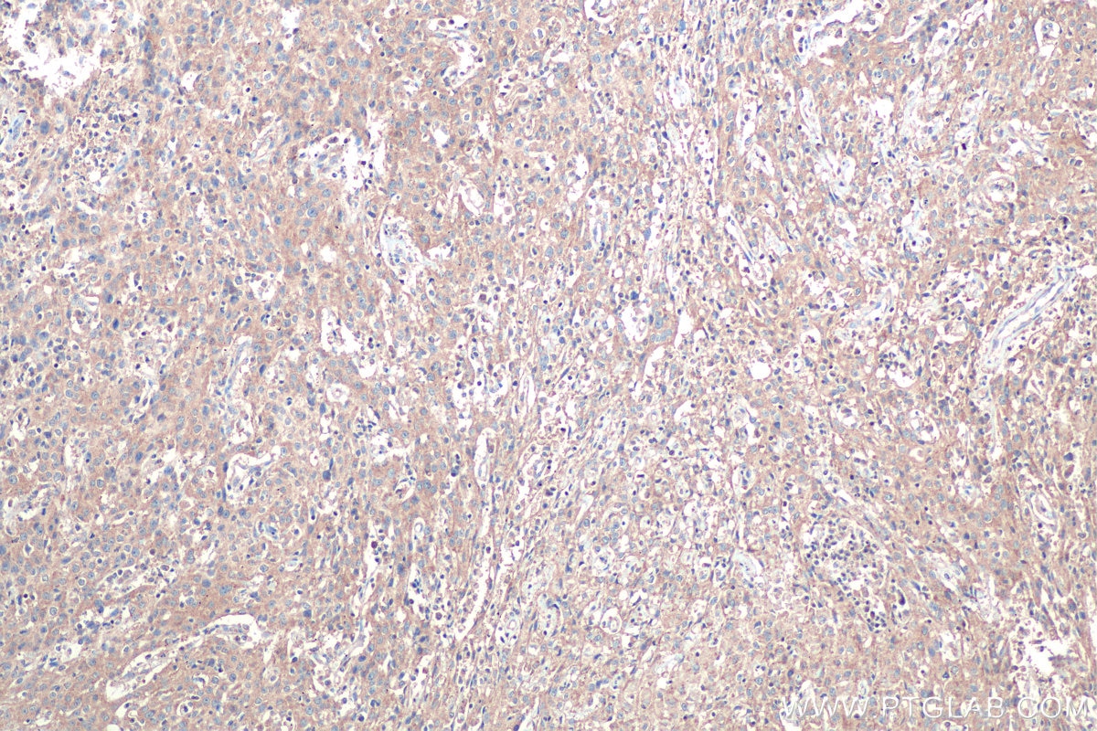 Immunohistochemical analysis of paraffin-embedded human cervical cancer tissue slide using KHC0919 (PRPSAP1 IHC Kit).
