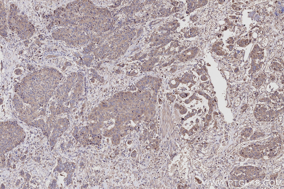 Immunohistochemical analysis of paraffin-embedded human stomach cancer tissue slide using KHC3076 (PRRC2C IHC Kit).