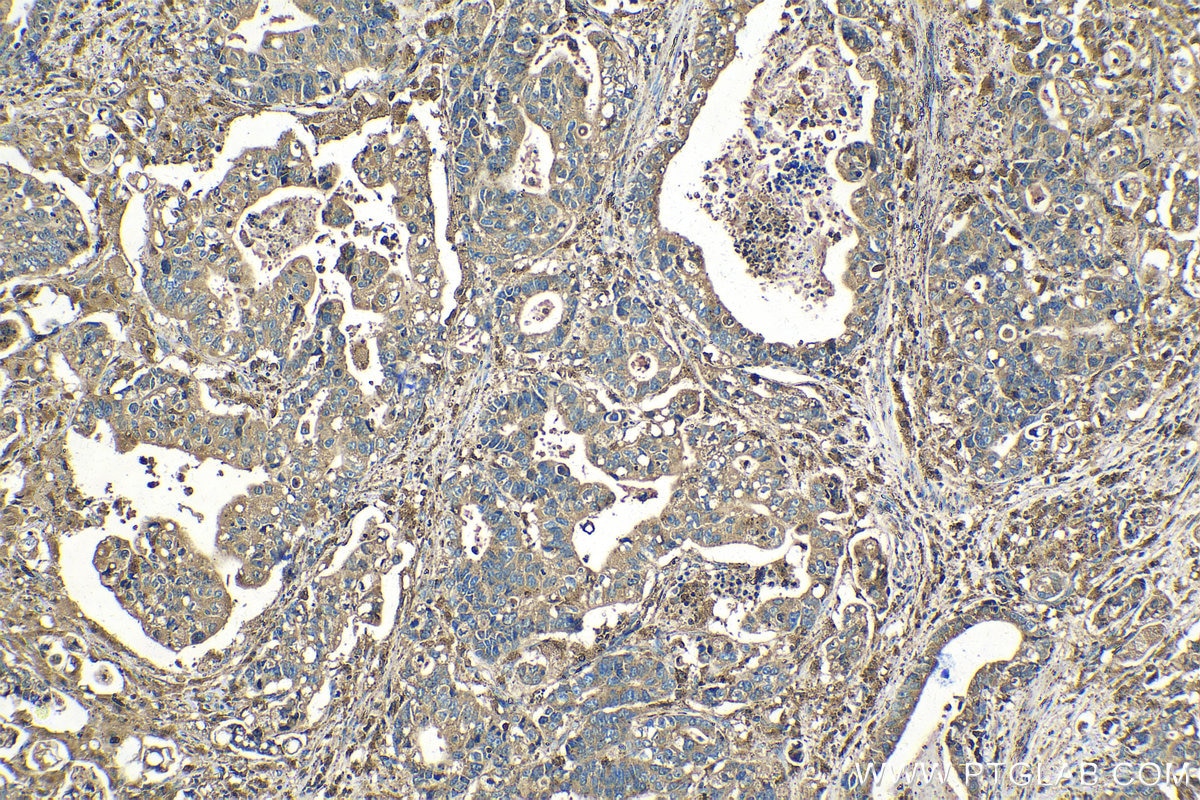 Immunohistochemical analysis of paraffin-embedded human stomach cancer tissue slide using KHC1407 (PSAP IHC Kit).