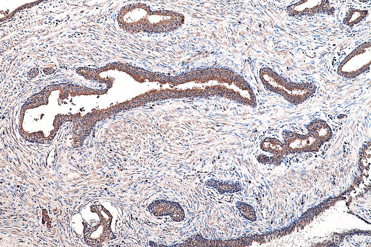 Immunohistochemical analysis of paraffin-embedded human prostate cancer tissue slide using KHC0243 (PSEN1/AD3 IHC Kit).