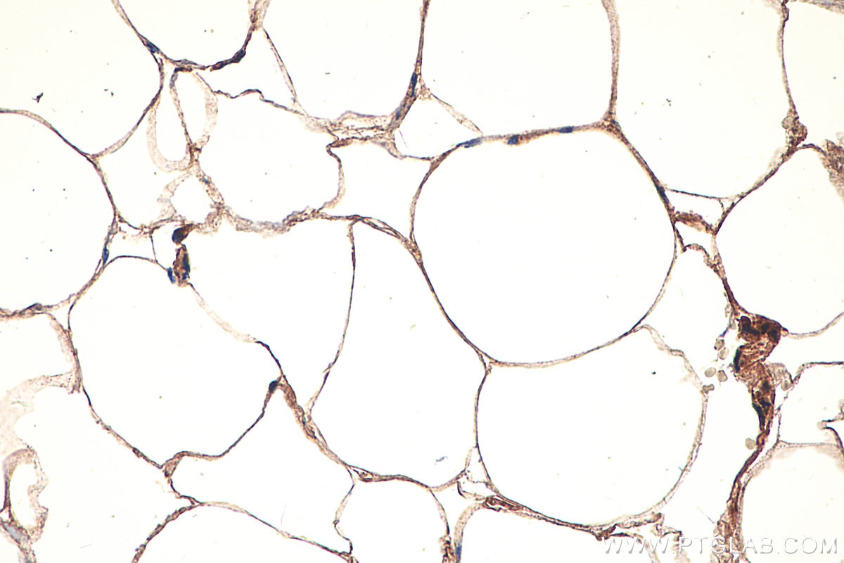 Immunohistochemical analysis of paraffin-embedded human prostate cancer tissue slide using KHC0243 (PSEN1/AD3 IHC Kit).