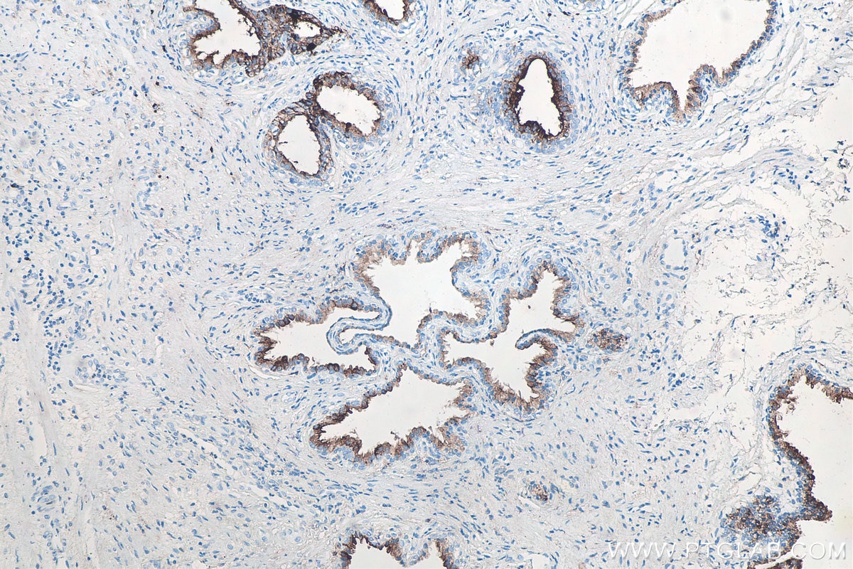 Immunohistochemical analysis of paraffin-embedded human prostate cancer tissue slide using KHC0066 (PSMA/FOLH1 IHC Kit).