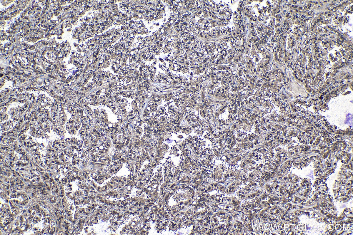 Immunohistochemical analysis of paraffin-embedded human lung cancer tissue slide using KHC1172 (PSMA1 IHC Kit).