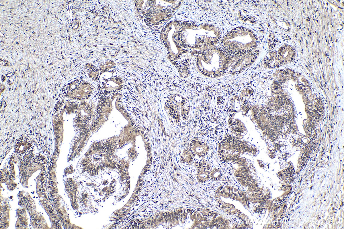 Immunohistochemical analysis of paraffin-embedded human pancreas cancer tissue slide using KHC1172 (PSMA1 IHC Kit).