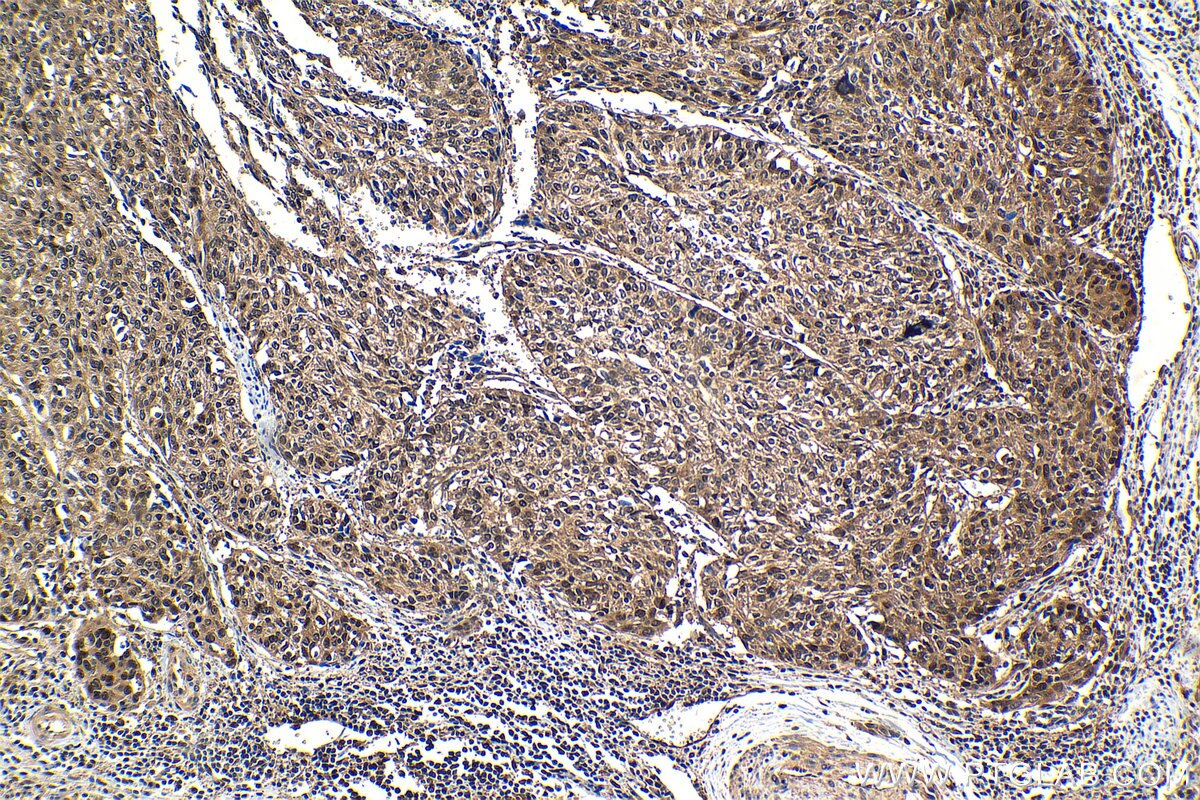 Immunohistochemical analysis of paraffin-embedded human cervical cancer tissue slide using KHC1305 (PSMA2 IHC Kit).