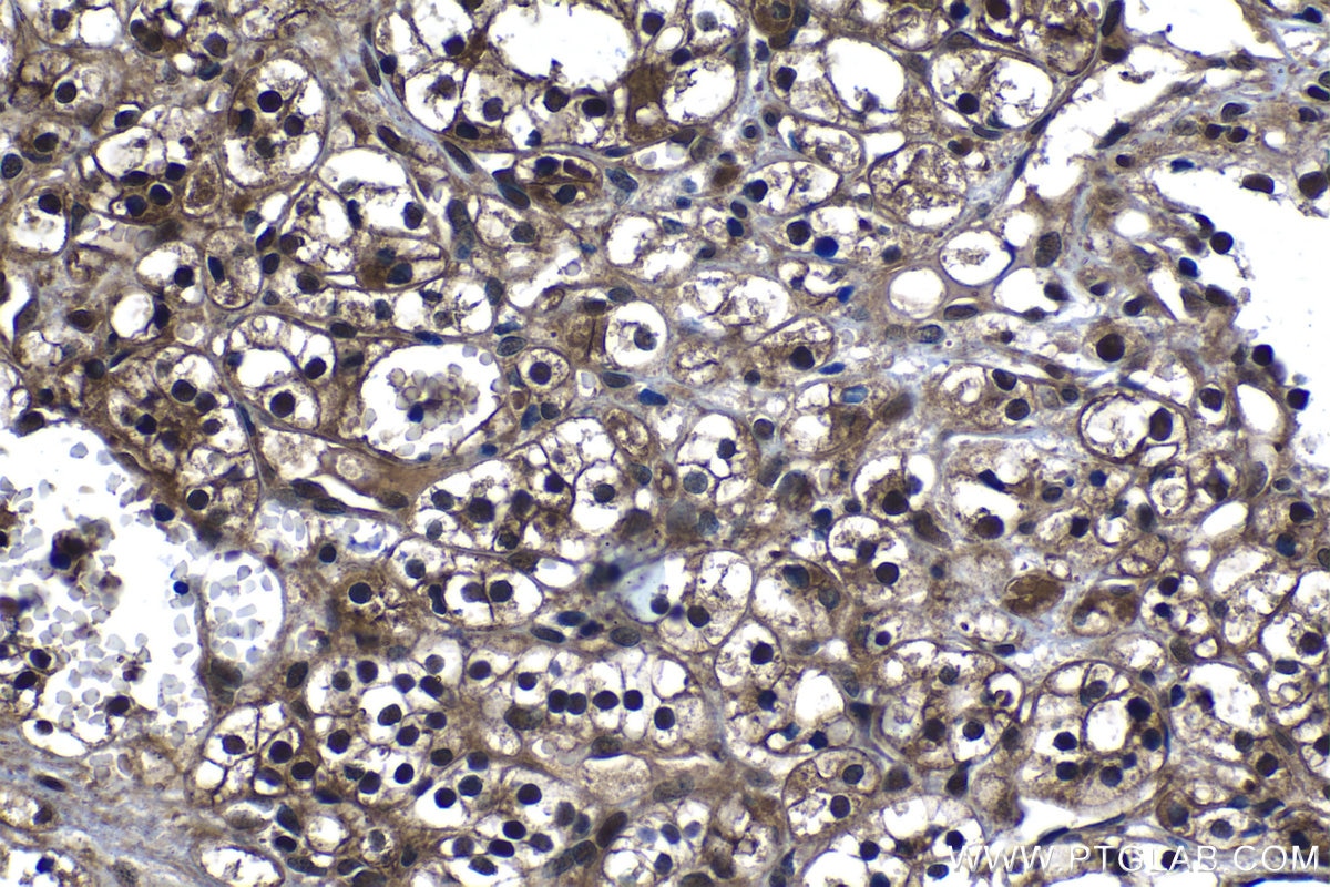 Immunohistochemical analysis of paraffin-embedded human renal cell carcinoma tissue slide using KHC1305 (PSMA2 IHC Kit).