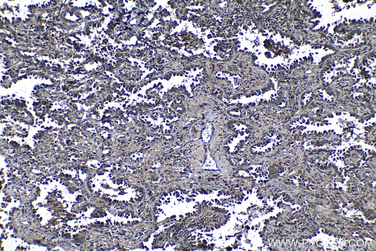 Immunohistochemical analysis of paraffin-embedded human lung cancer tissue slide using KHC1305 (PSMA2 IHC Kit).