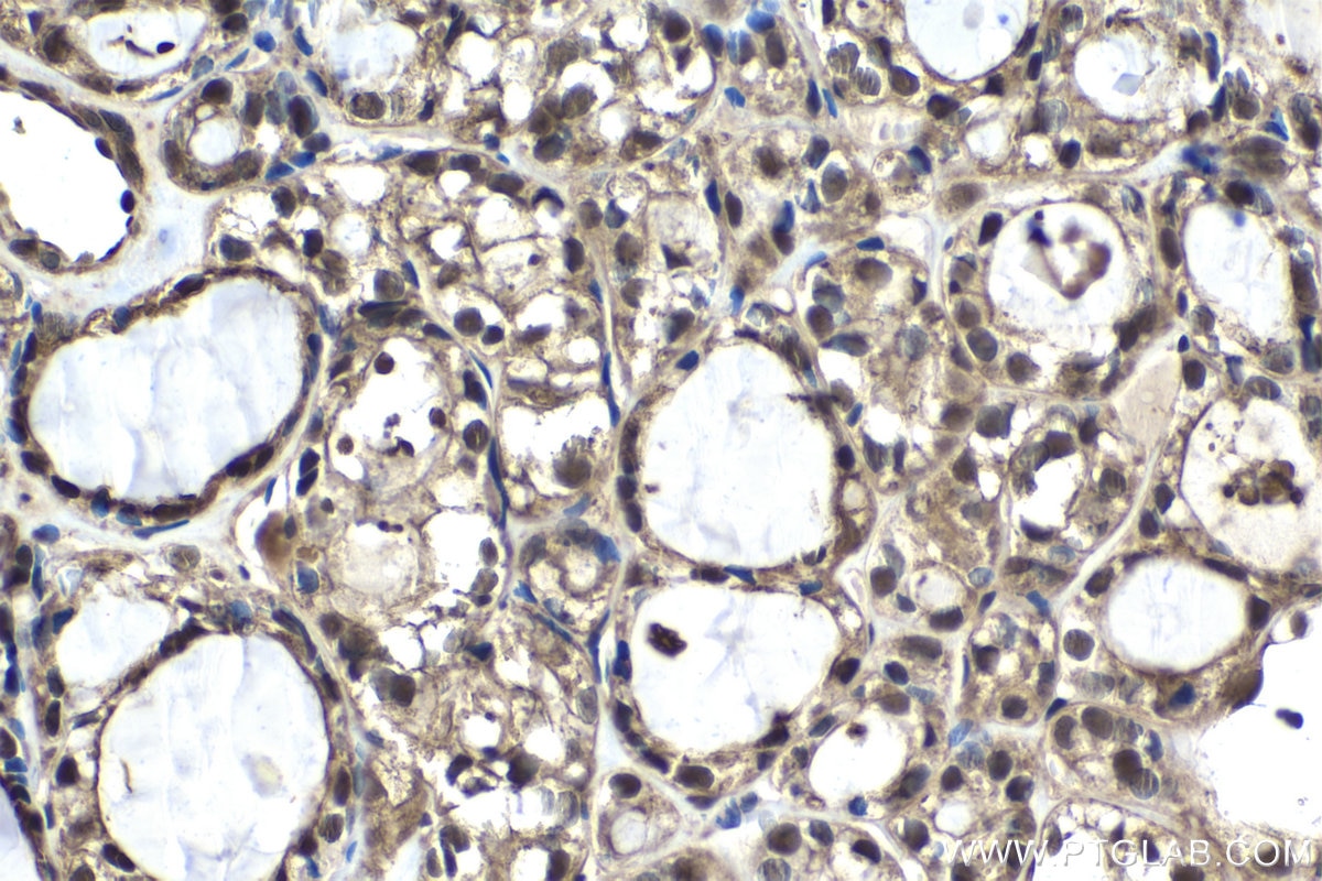 Immunohistochemical analysis of paraffin-embedded human thyroid cancer tissue slide using KHC1563 (PSMA3 IHC Kit).
