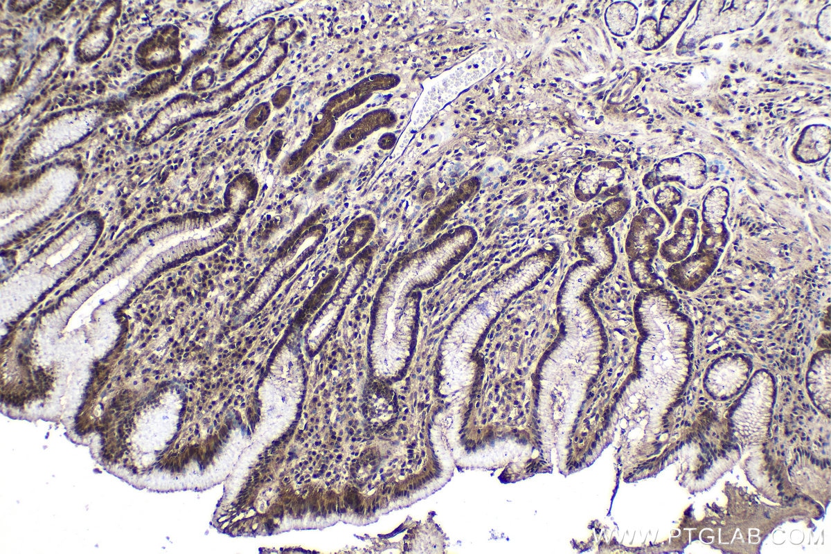 Immunohistochemical analysis of paraffin-embedded human stomach cancer tissue slide using KHC1564 (PSMA4 IHC Kit).